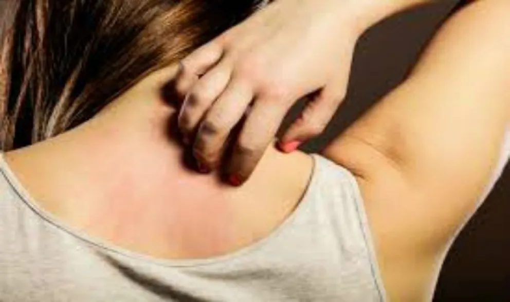 Urticaria por calor: cómo reconocerla y evitar su aparición