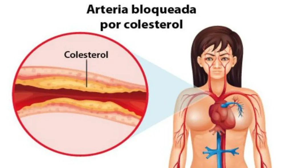 Lo que hay que saber sobre el colesterol