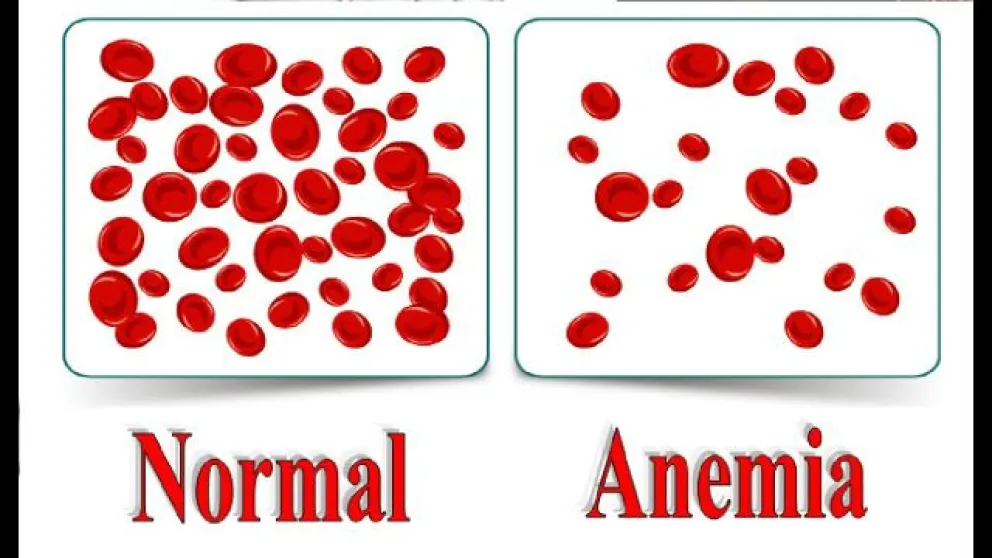 Anemia: Tipos, causas y síntomas