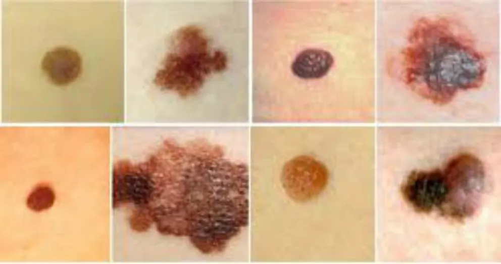 Lunares: ¿cuándo consultar?