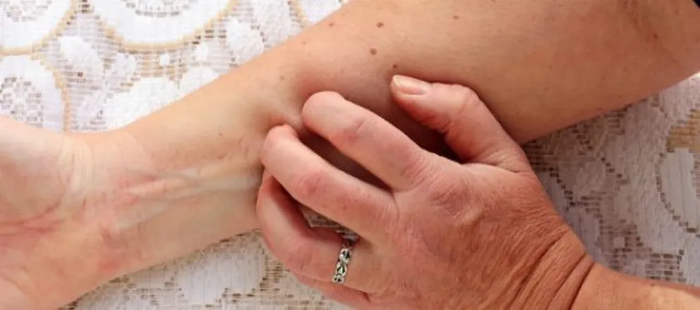 Alergia por el calor: síntomas y soluciones naturales