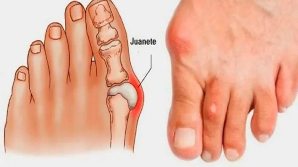 Hallux valgus: el llamado “juanete”