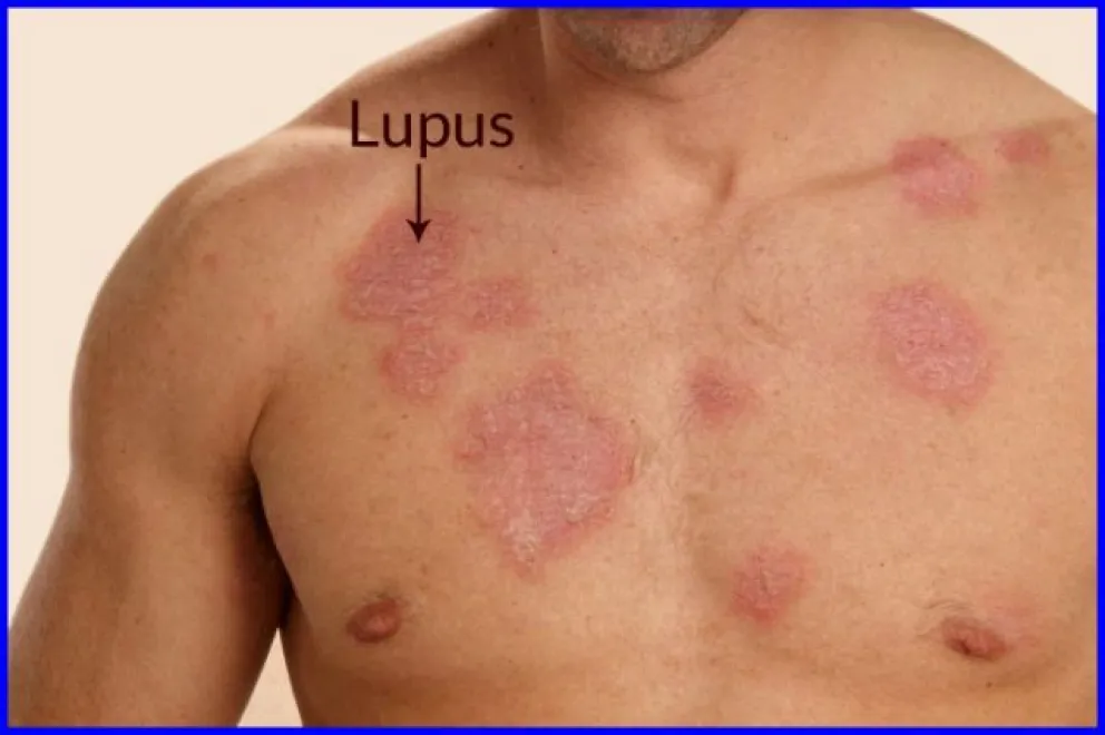 Lupus: la silenciosa enfermedad que aún no tiene cura