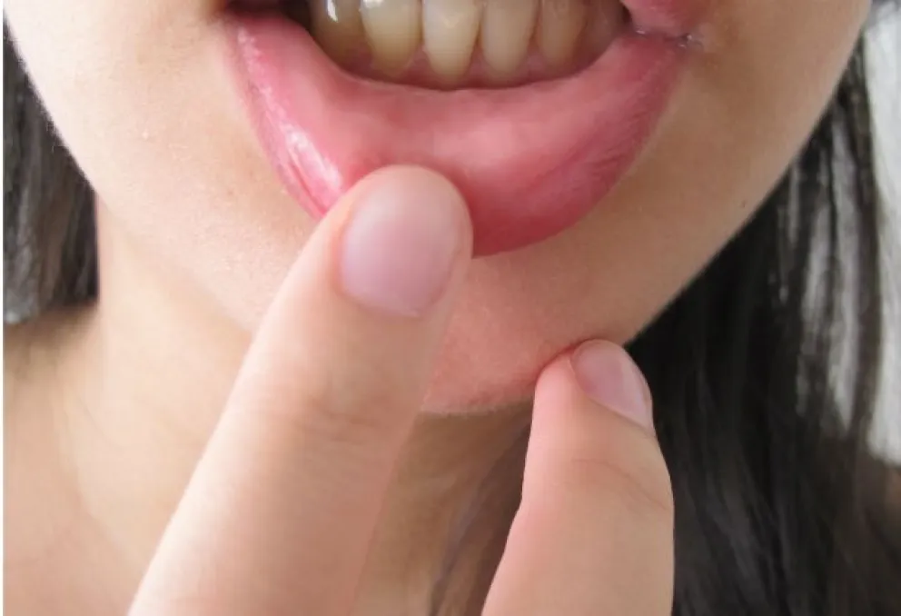 Estomatitis: tipos, causas y tratamientos