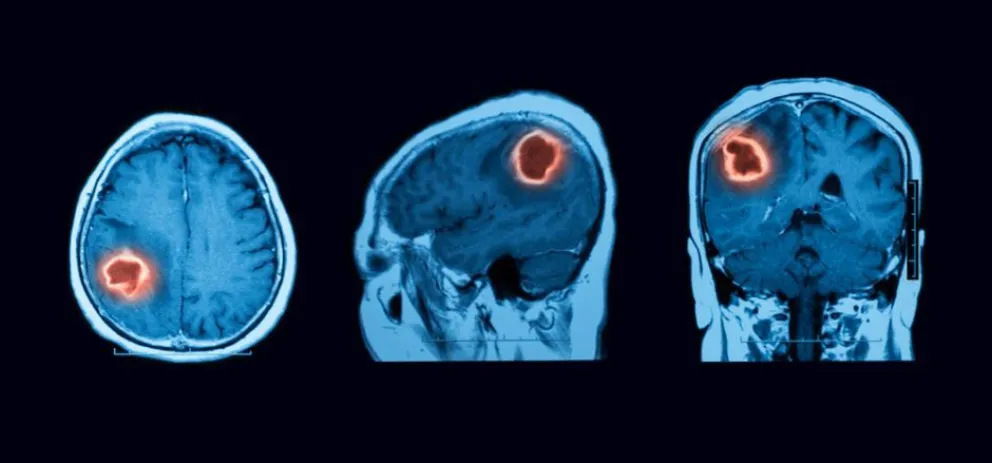 Avance argentino para tratar un tumor cerebral en adultos