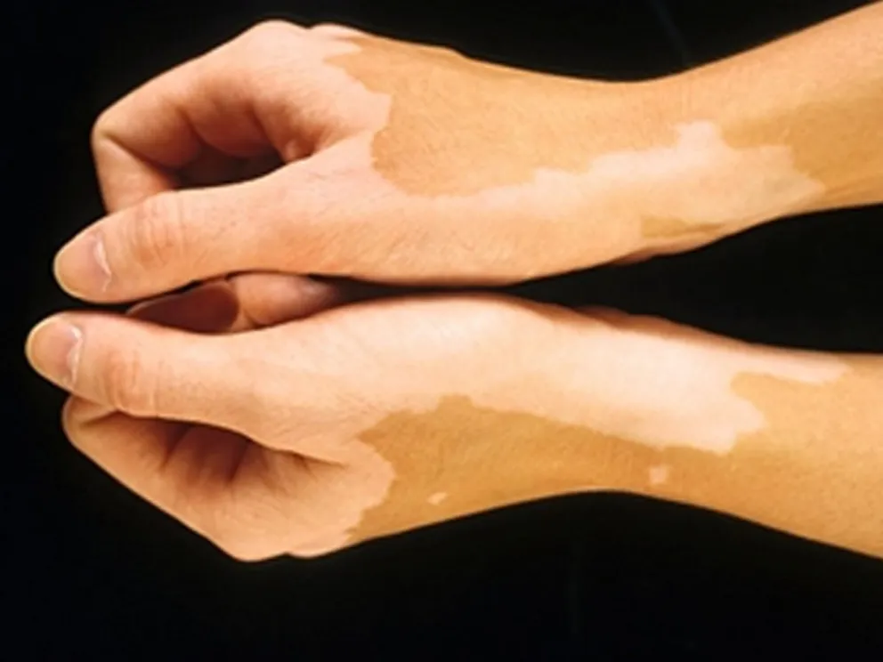 Día mundial del Vitiligo