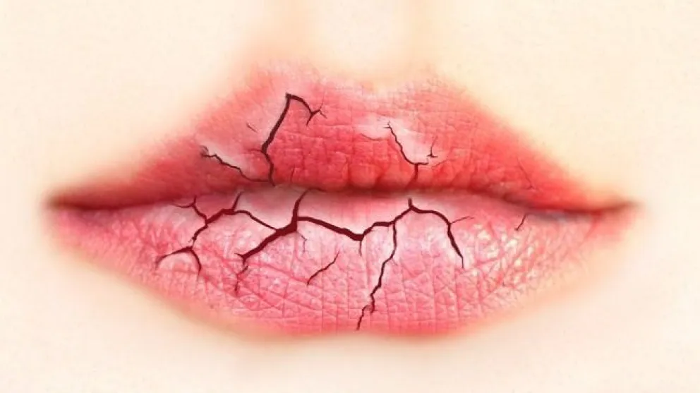 Cuidá tus labios en invierno