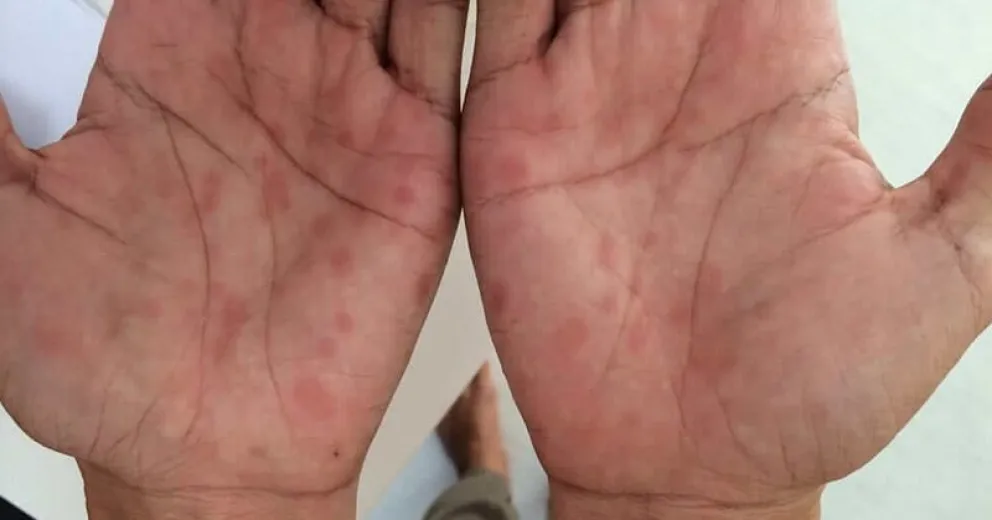 Llaman a la prevención por casos de sífilis