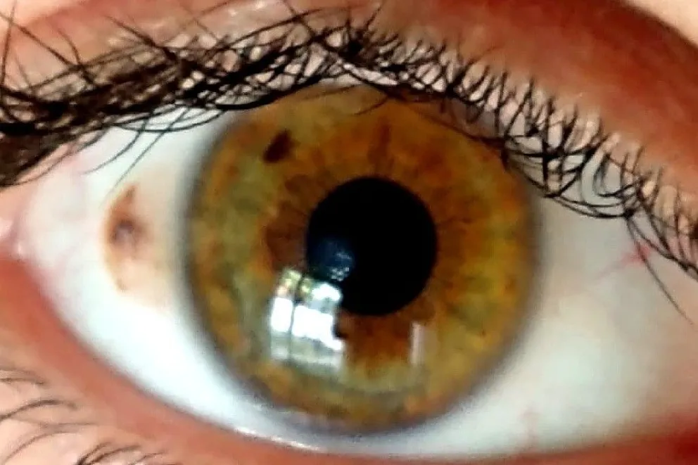 Nuevo operativo de ablación corneal en Río Negro