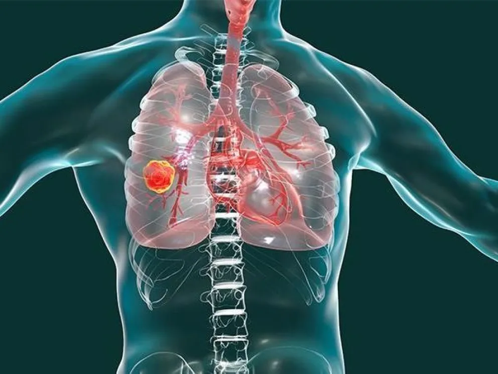 Bronquiolitis obliterante, enfermedad pulmonar vinculada al vapeo