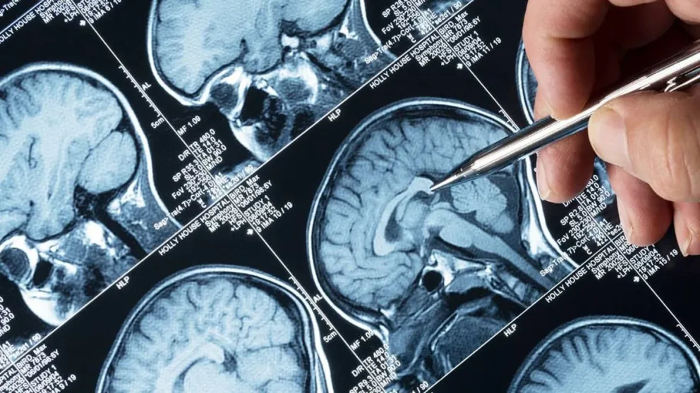 Cerca de 50 millones de personas padecen de epilepsia en el mundo