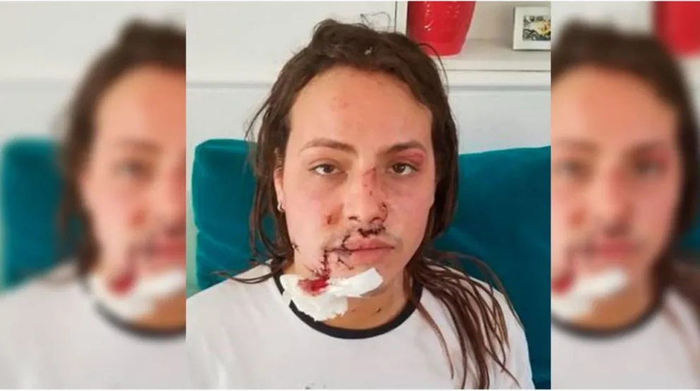 Joven trans fue acuchillada y se defendió del ataque con un vidrio