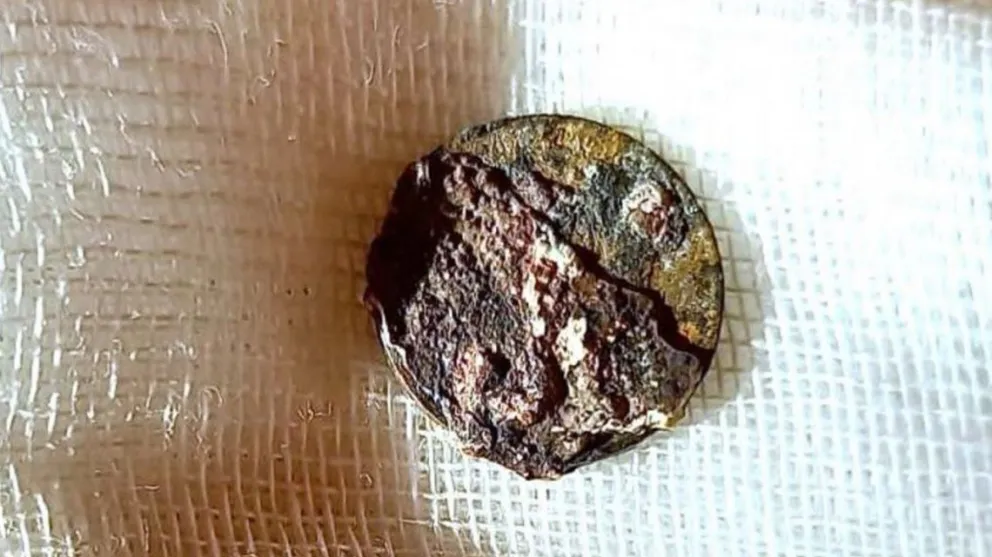 Rusia: le extrajeron una moneda que se metió en la nariz hace 53 años