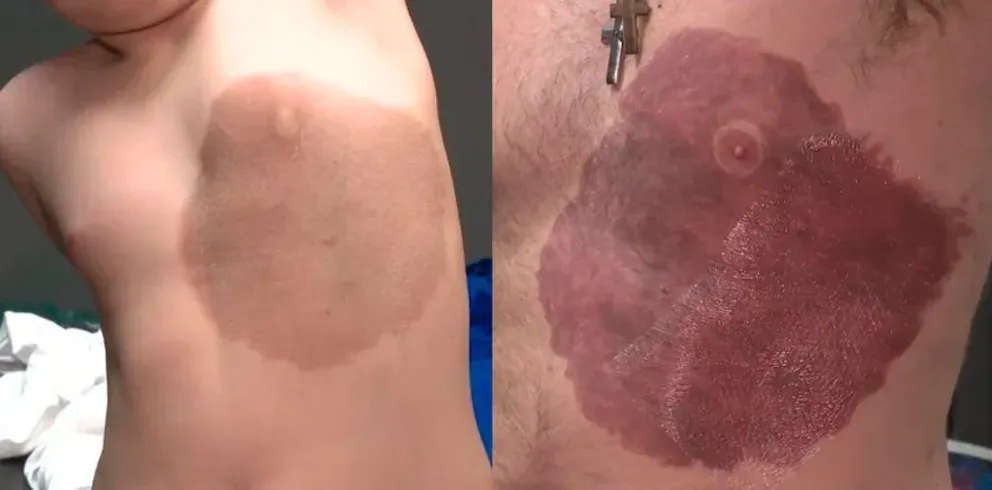 Canadá: se tatuó la mancha de nacimiento de su hijo para darle confianza
