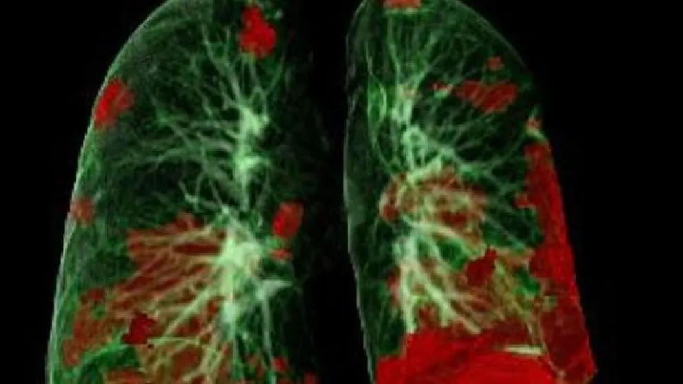 Aseguran que los pulmones después del Covid quedan peor que los de los fumadores