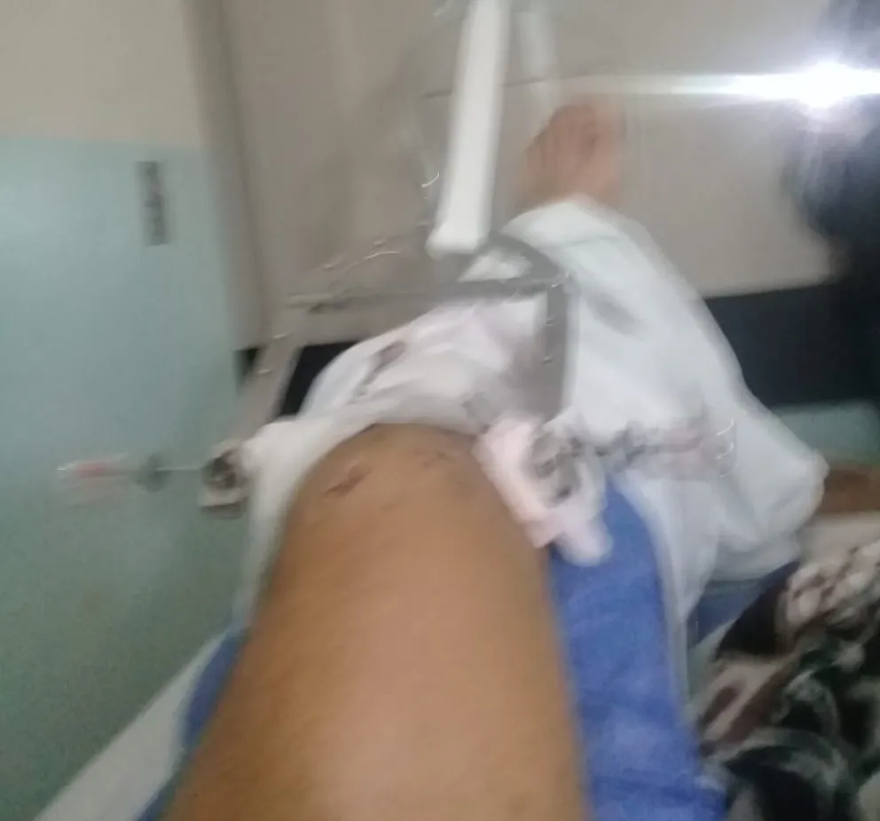 "Me arruino la vida": joven acusó que un taxista giró en U y le rompió el fémur