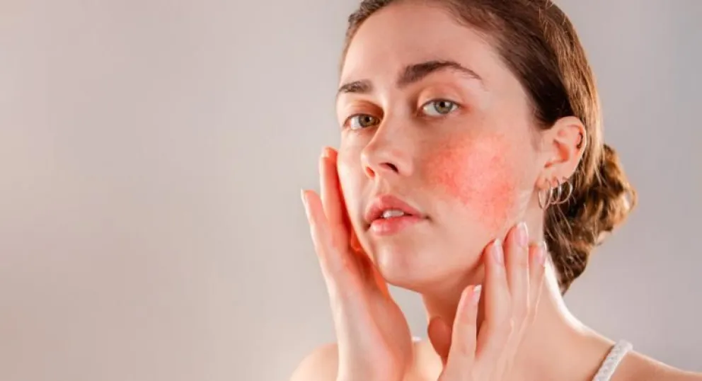 Qué es la rosácea y cómo cuidarse del sol: todo lo que tenés que saber 