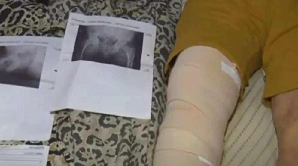 Insólita excusa: necesitaba una cirugía de cadera y terminan operándolo de una rodilla