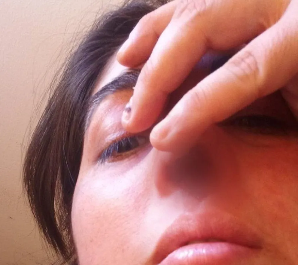 Por un hisopado mal hecho perdió el cartílago de la nariz