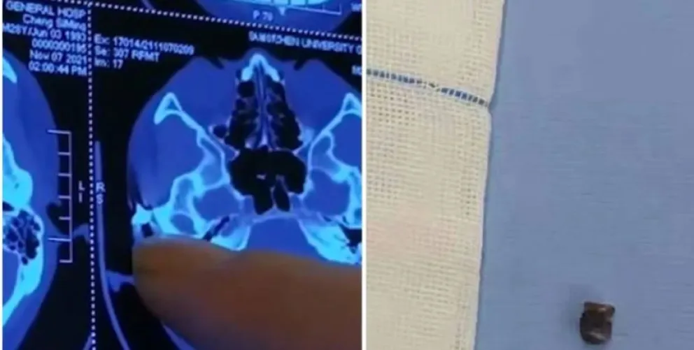 Vivió con dolor de cabeza durante 20 años y descubrieron algo impresionante